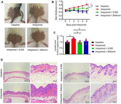 Pyruvate Kinase M2 Mediates Glycolysis Contributes to Psoriasis by Promoting Keratinocyte Proliferation